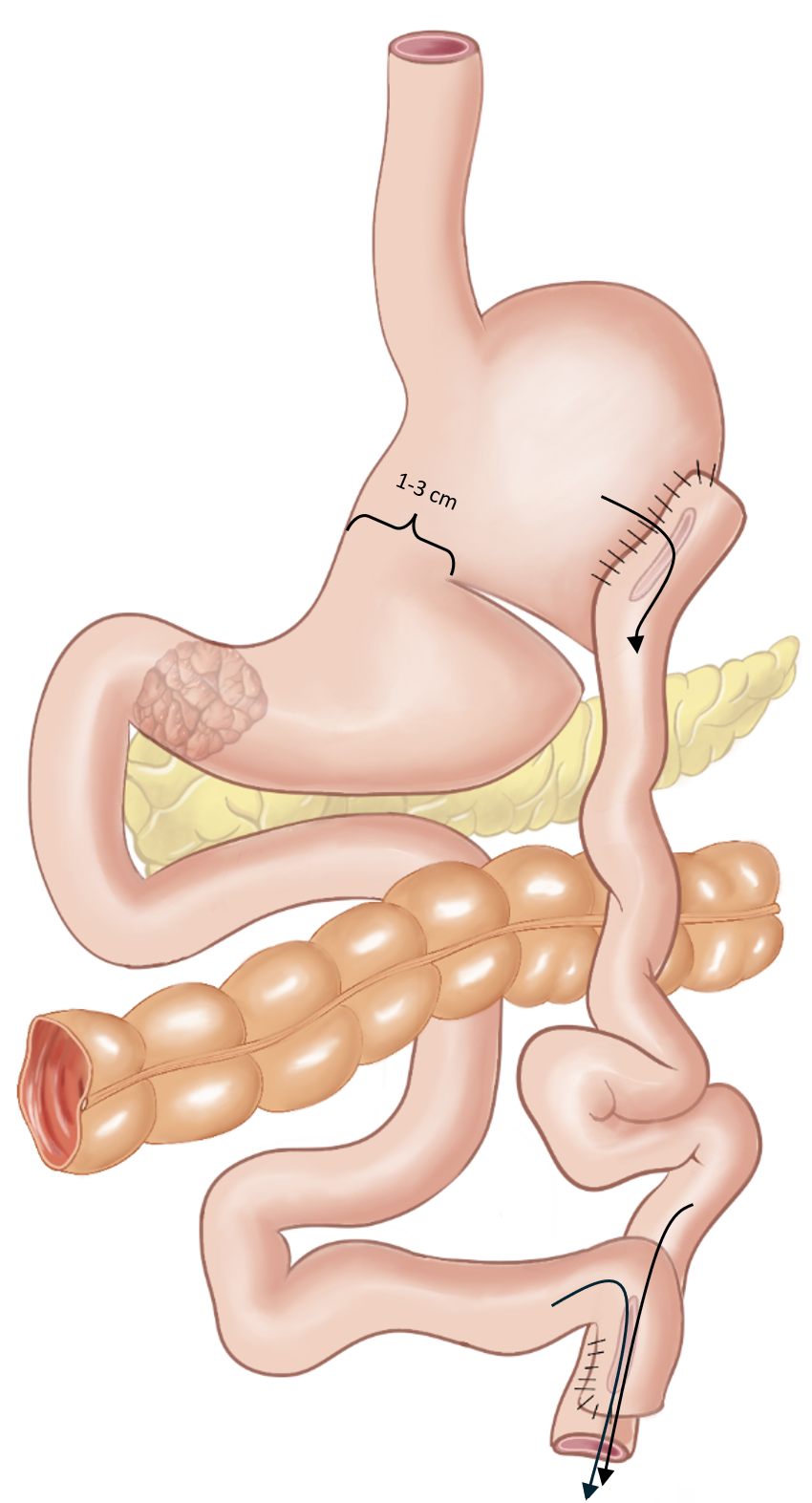 Figur 10: «Devine» gastroenterostomi. (G. Al-Haidari)