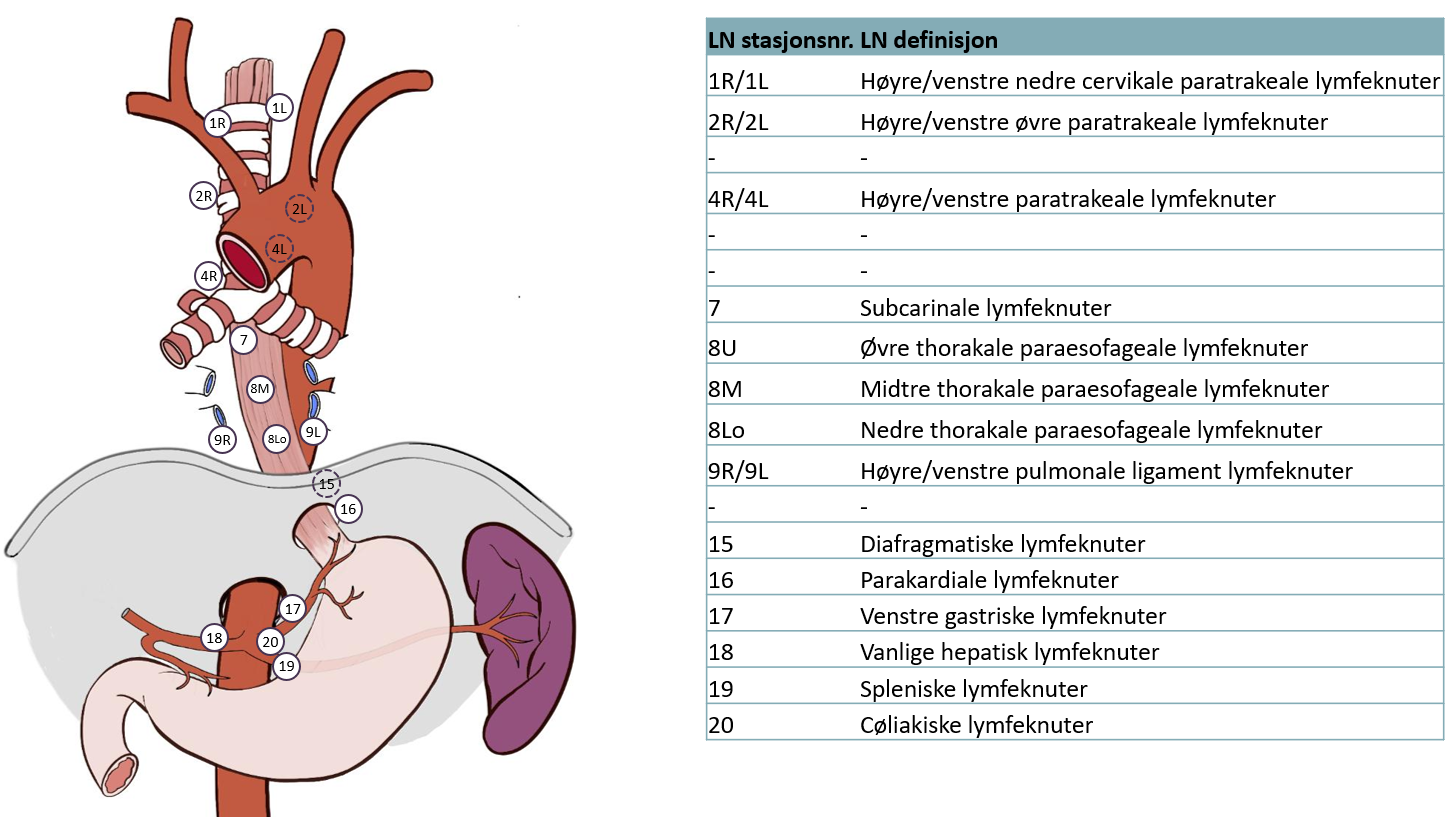 Figur 6 viser aktuelle glandelstasjoner ved spiserørskreft i hht. 8. utgave av UICC/AJCC TNM fra 2018. Gjengitt fra Rice et al. (2017) og Wang et al. (2018). CC BY 4.0. Med tillatalelse fra Elsevier i 2024.