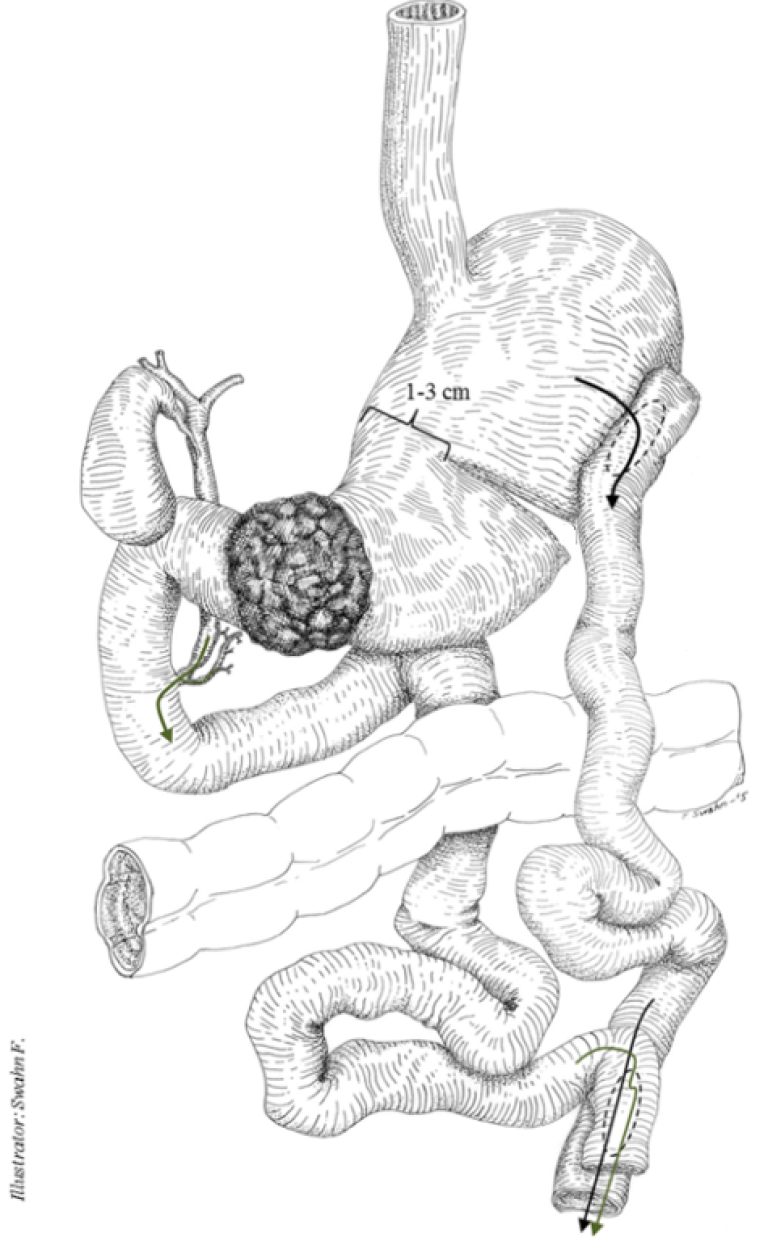 Figur 10: «Devine» gastroenterostomi. Gjengitt fra Kumagai et al. (2016). Med tillatelse fra Springer Nature i 2024.