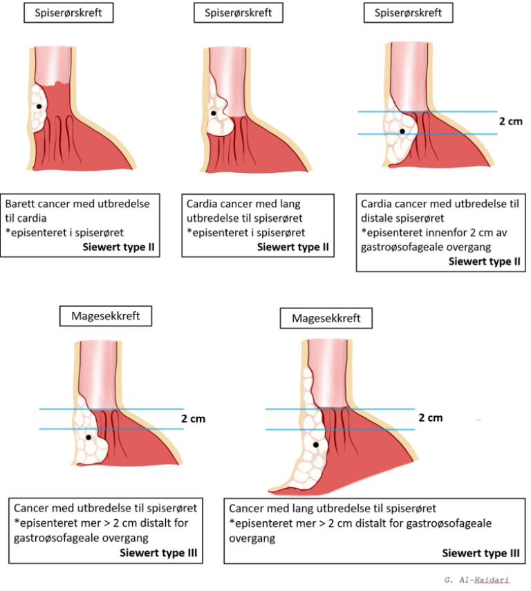 Figur 4: Klassifikasjon av kreftsvulster i den gastroøsofageale overgang. Kilde: Egenprodusert. G. Al-Haidari.